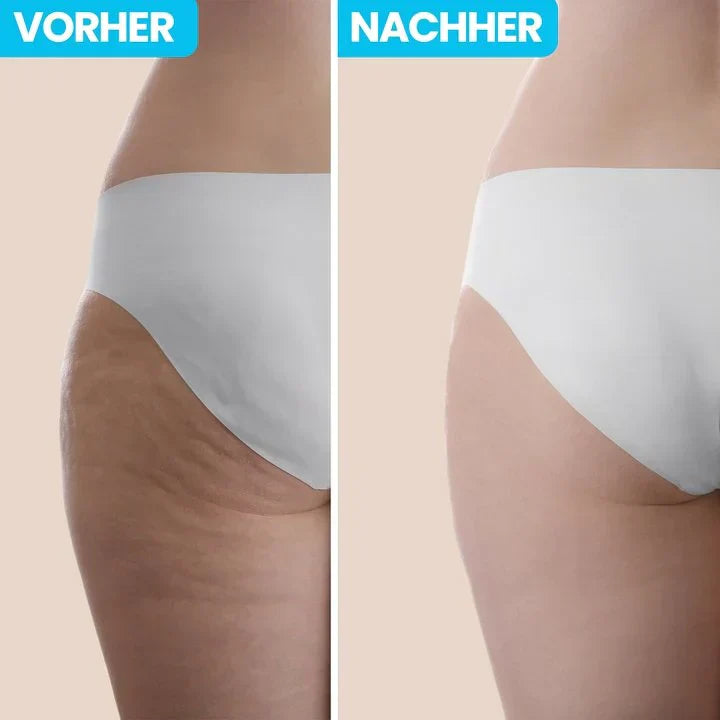60% Rabatt | CelluPro™️ Entfernen Sie Cellulite bequem von zu Hause!