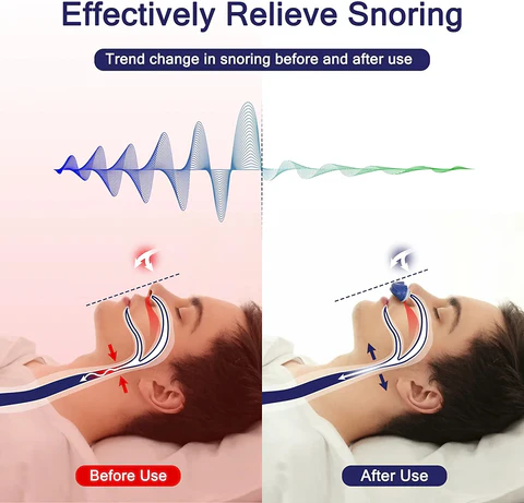 Micro CPAP Sleep Apnea Device for Travel & Against Snoring - CPAP Alternative