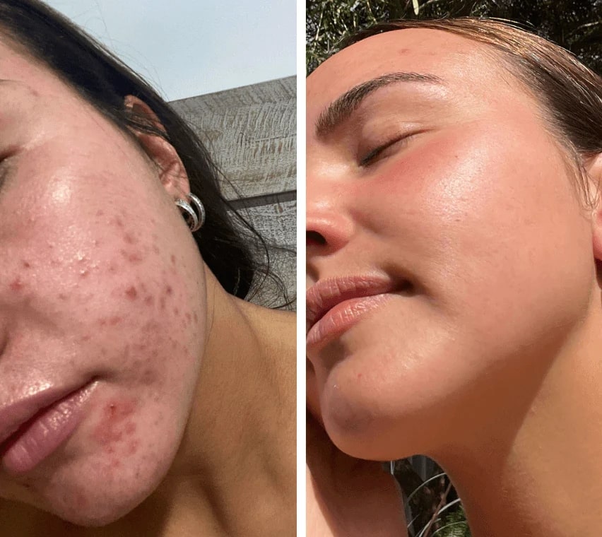 Red Light Mask | LED Face Mask | Light Therapy for Skin | SkinGlow