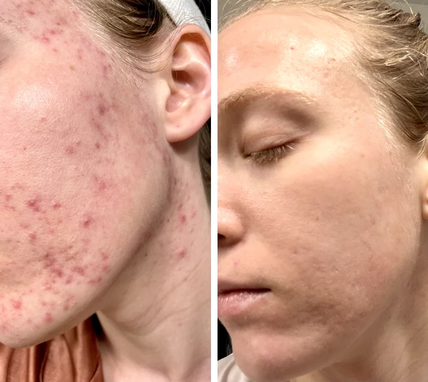 Red Light Mask | LED Face Mask | Light Therapy for Skin | SkinGlow