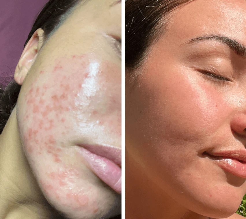 Red Light Mask | LED Face Mask | Light Therapy for Skin | SkinGlow